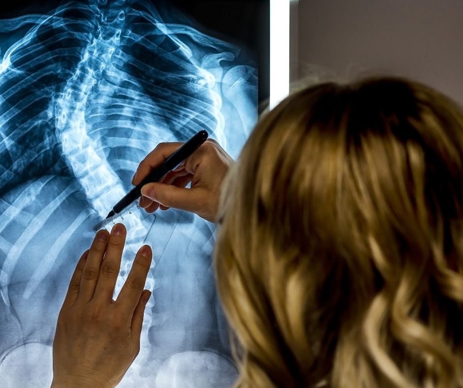 Reviewing an x-ray of a scoliosis patient