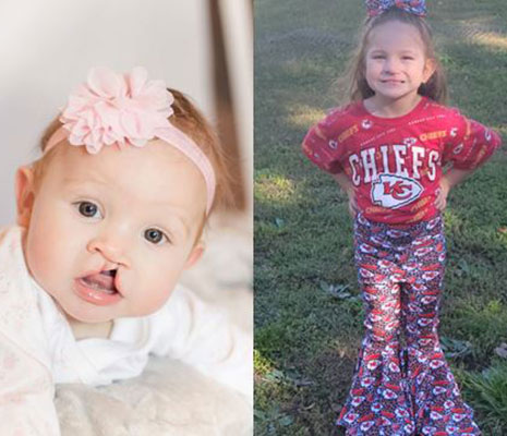 Adlei Minor smiles as a baby, prior to her cleft lip and palate surgery, and then again as a child , wearing Kansas City Chiefs fan gear.