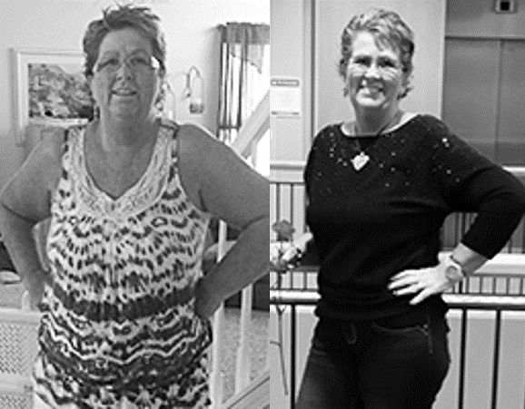 Dee White before and after weight loss surgery.