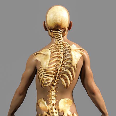 A 3D rendering of a transparent body with illustrated skeleton with scoliosis symptoms. 