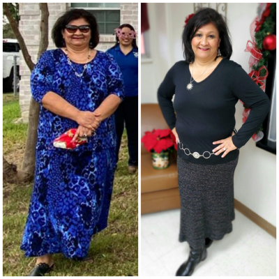 Rosa Rakay, before and after weight loss surgery.